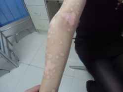 白癜风治疗
