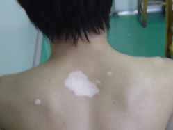 白癜风治疗