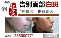 南宁白癜风哪里效果好